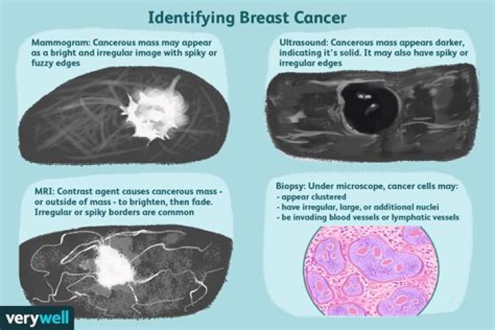 Do lumpy breasts mean cancer?