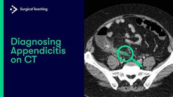 Does chronic appendicitis show on CT scan?