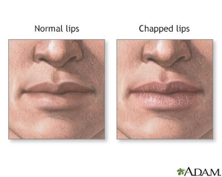 Why are my lips so chapped?