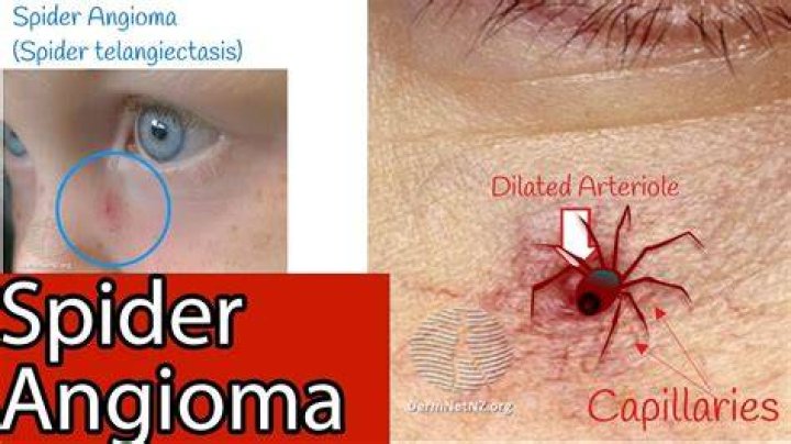 Why do spider angiomas occur?